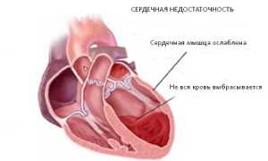 Ибс постинфарктный кардиосклероз