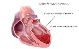 Ибс постинфарктный кардиосклероз