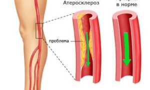 Атеросклероз сосудов нижних конечностей симптомы диагностика