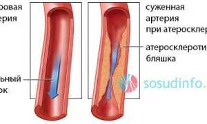 Окклюзия сонной артерии операция