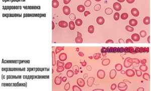 Гипохромная железодефицитная анемия