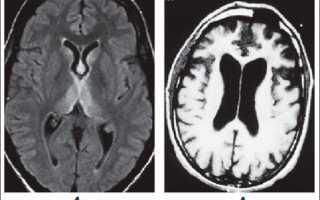 Симптомы энцефалопатии головного мозга у взрослых