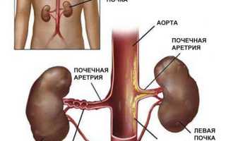 Стеноз почечной артерии лечение