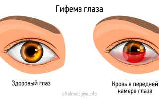 Гифема глаза лечение