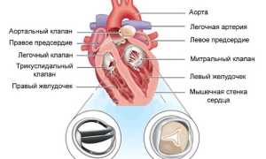 Протезирование митрального клапана сердца прогноз